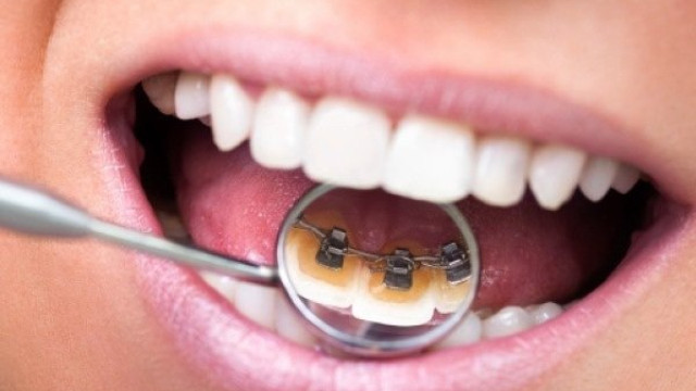 Chăm sóc răng miệng đúng cách trong suốt quá trình niềng răng Chăm sóc răng miệng đúng cách trong suốt quá trình niềng răng