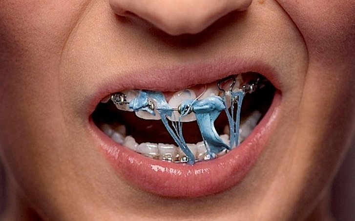 Chăm sóc răng miệng đúng cách trong suốt quá trình niềng răng