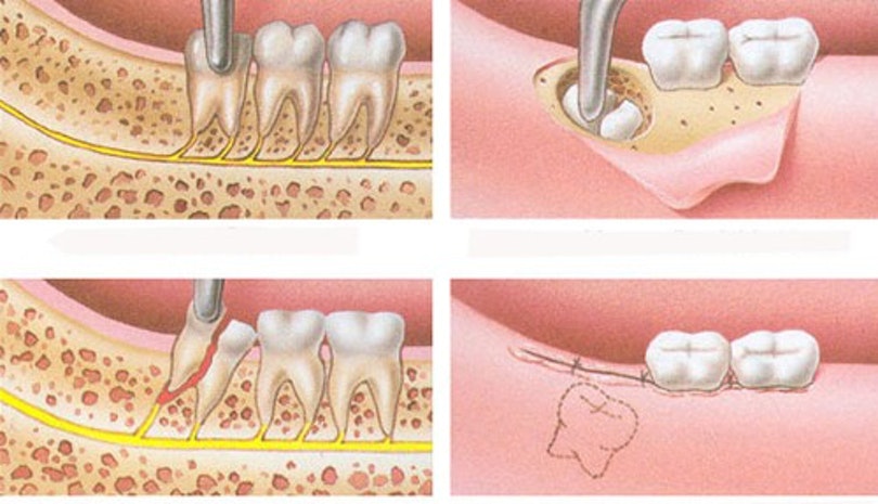 Dấu hiệu cần nhổ răng khôn