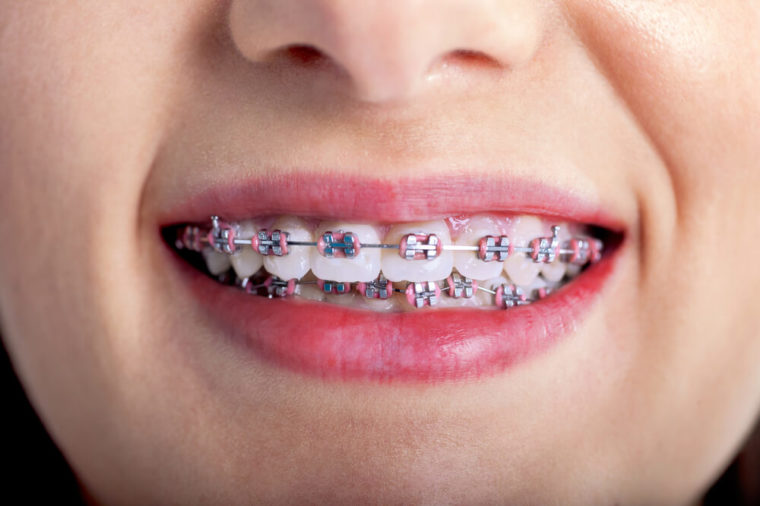 Giải đắp một số thắc mắc về niềng răng