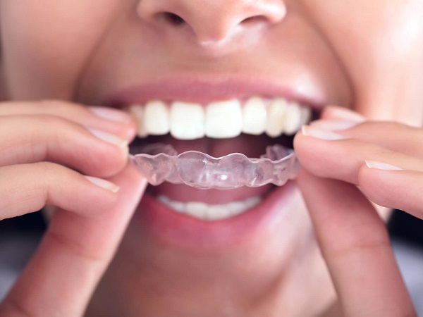 Giải đắp một số thắc mắc về niềng răng