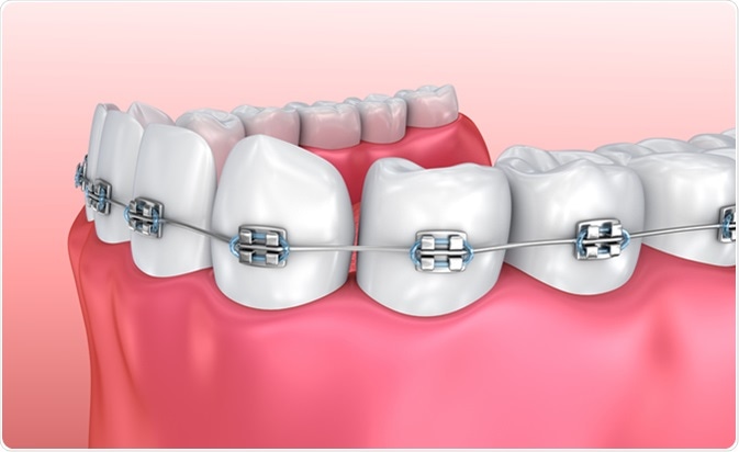 Giải đắp một số thắc mắc về niềng răng