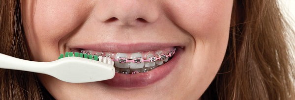 Giải đắp một số thắc mắc về niềng răng