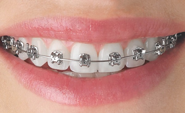 Giải đắp một số thắc mắc về niềng răng