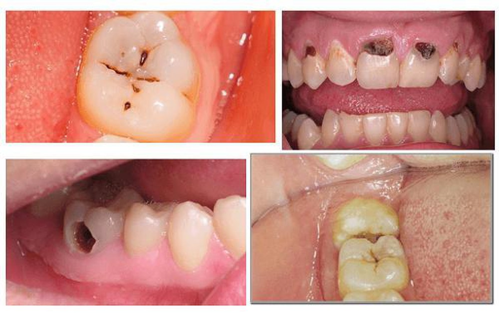 Răng trám bị sâu lại thì phải làm thế nào Răng trám bị sâu lại thì phải làm thế nào