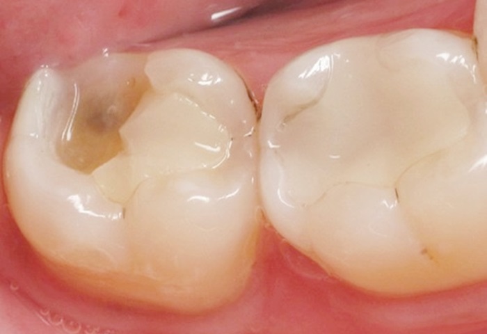 Răng trám bị sâu lại thì phải làm thế nào Răng trám bị sâu lại thì phải làm thế nào