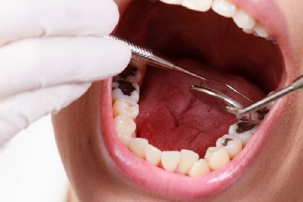 Răng trám bị sâu lại thì phải làm thế nào Răng trám bị sâu lại thì phải làm thế nào