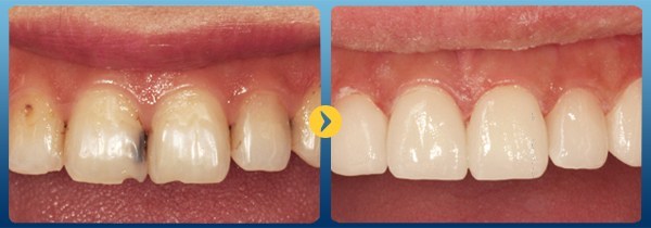 Răng trám bị sâu lại thì phải làm thế nào Răng trám bị sâu lại thì phải làm thế nào