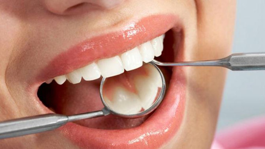 Răng trám bị sâu lại thì phải làm thế nào Răng trám bị sâu lại thì phải làm thế nào