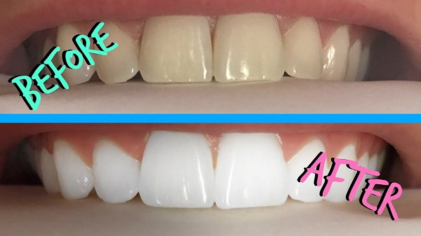 10 bí mật giúp răng bạn luôn trắng sáng