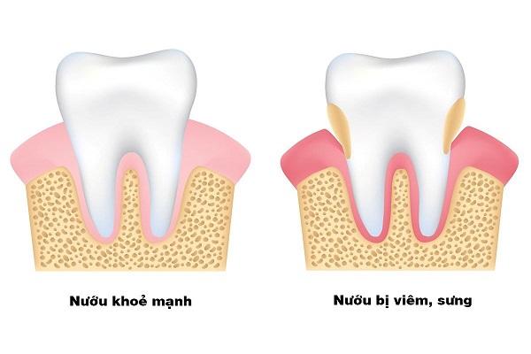 4 lý do hàng đầu cần kiểm tra sức khỏe răng miệng thường xuyên