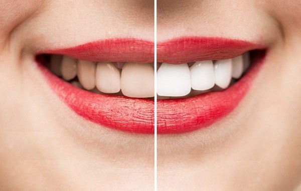 5 cách làm trắng răng hiệu quả tại nhà 5 cách làm trắng răng hiệu quả tại nhà