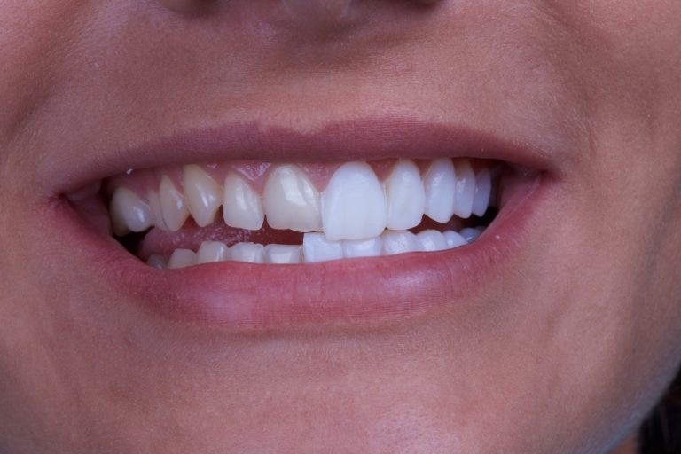 5 lợi ích của việc bọc răng sứ