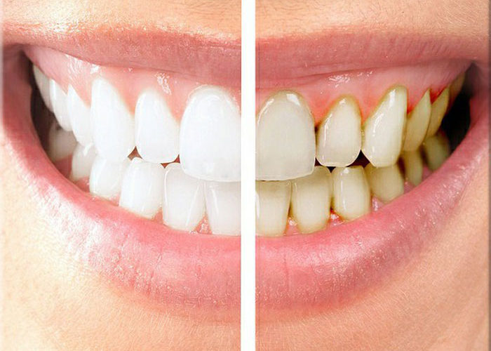 5 lợi ích của việc bọc răng sứ 5 lợi ích của việc bọc răng sứ