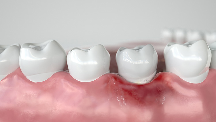 5 vấn đề sức khỏe răng miệng hàng đầu ở người cao tuổi