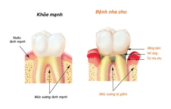 Bệnh về răng