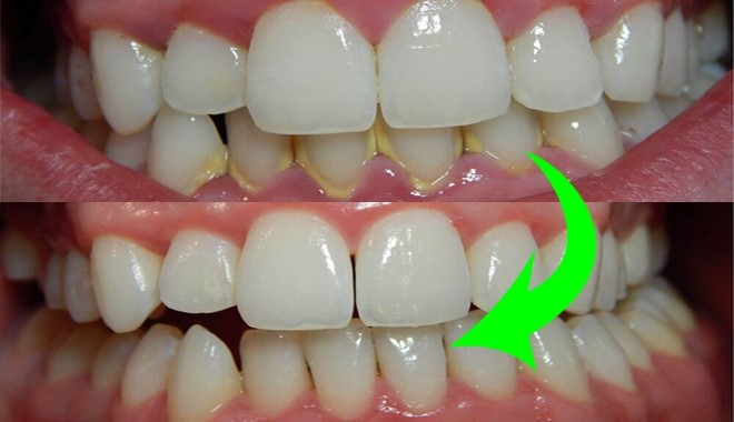 Bạn có biết lấy cao răng thường xuyên giúp răng khỏe mạnh hơn