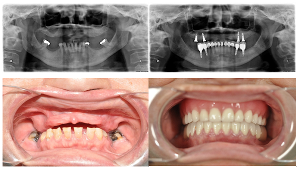 Bảng giá răng tháo lắp