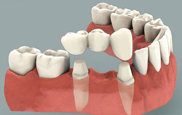 Bảng giá răng tháo lắp Bảng giá răng tháo lắp