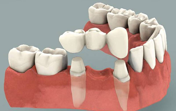 Bảng giá răng tháo lắp