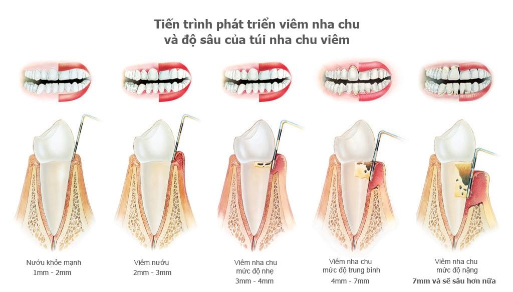 Bệnh viêm nha chu và những điều cần biết cho gia đình bạn