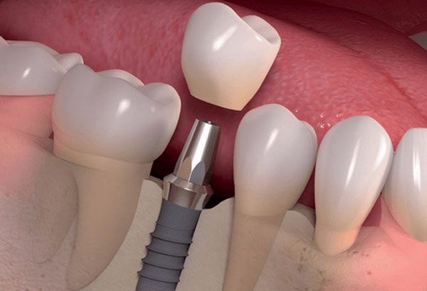 Bệnh viêm quanh implant ở bệnh nhân trồng răng implant