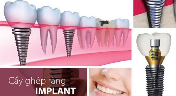 Bệnh viêm quanh implant ở bệnh nhân trồng răng implant