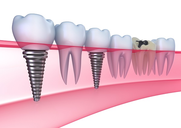 Bệnh viêm quanh implant ở bệnh nhân trồng răng implant
