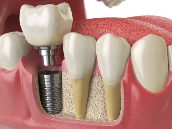 Bệnh viêm quanh implant ở bệnh nhân trồng răng implant