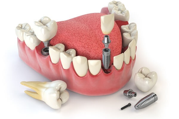 Bệnh viêm quanh implant ở bệnh nhân trồng răng implant