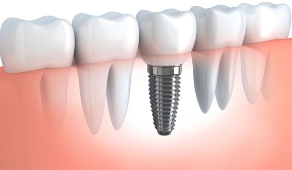 Bệnh viêm quanh implant ở bệnh nhân trồng răng implant