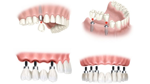 Bệnh viêm quanh implant ở bệnh nhân trồng răng implant