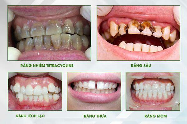 Bọc răng sứ hiệu quả cho những trường hợp răng nào
