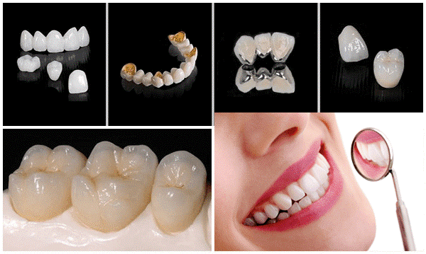 bọc răng sứ tại tân phú bọc răng sứ tại tân phú