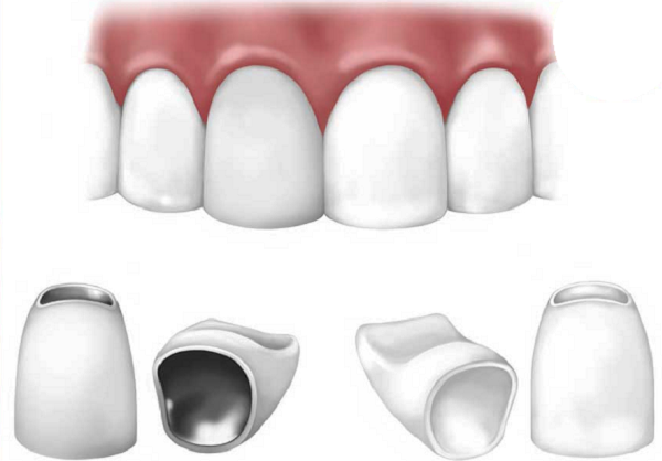 bọc răng sứ thẩm mỹ