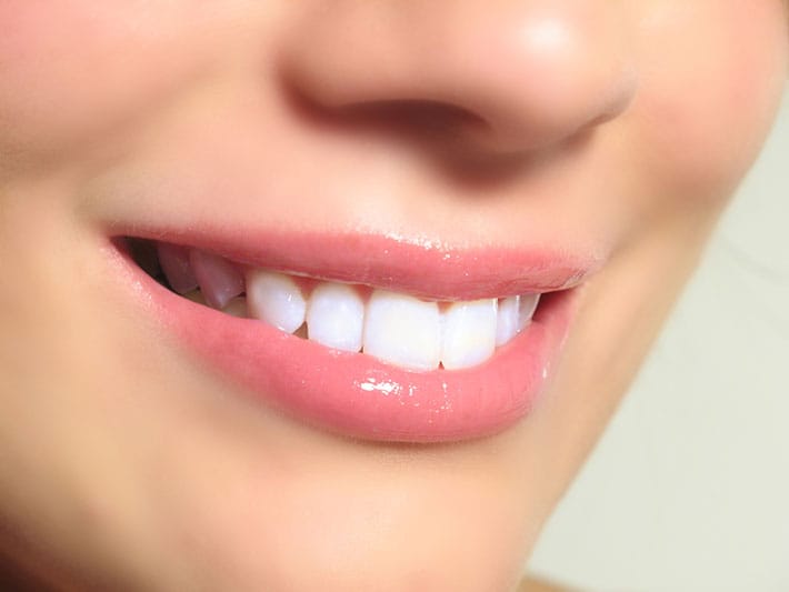 bọc răng sứ thẩm mỹ