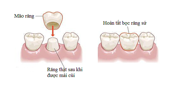 bọc răng sứ thẩm mỹ