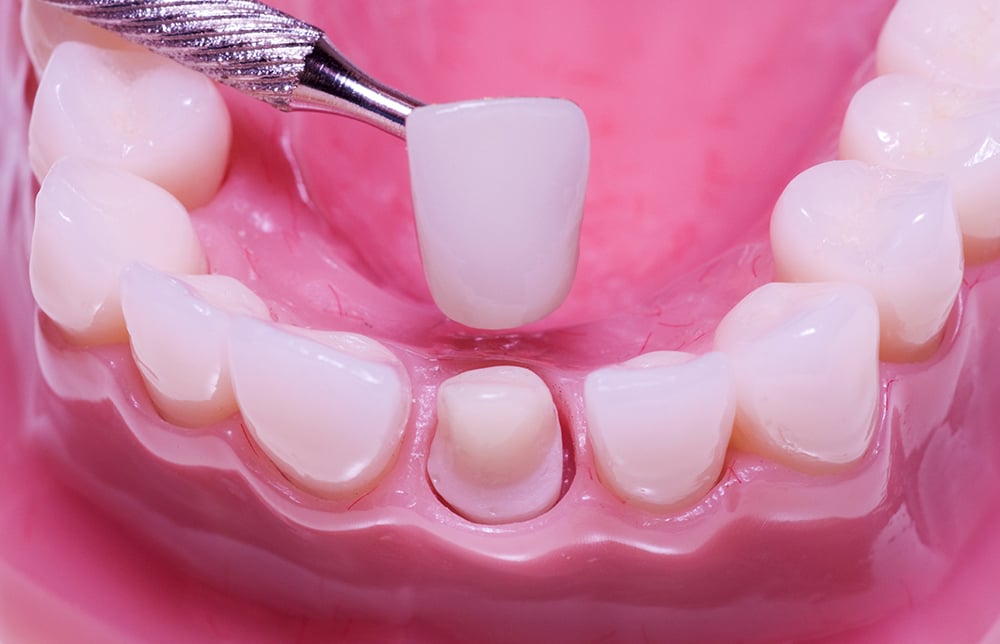 Tìm hiểu về các loại răng sứ trên thị trường hiện nay Tìm hiểu về các loại răng sứ trên thị trường hiện nay