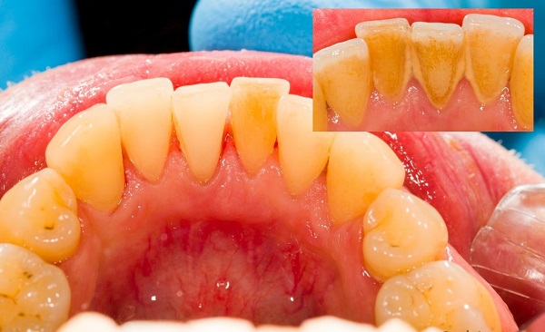 Các vấn đề thường gặp về chăm sóc răng miệng