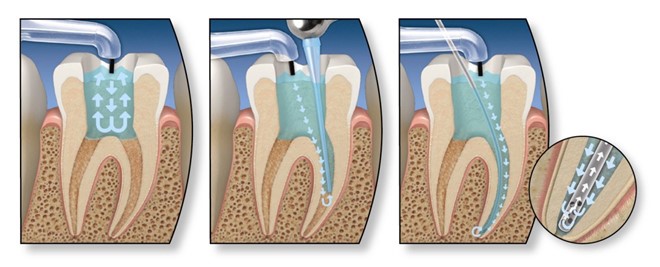 Cách điều trị tủy răng – nội nha
