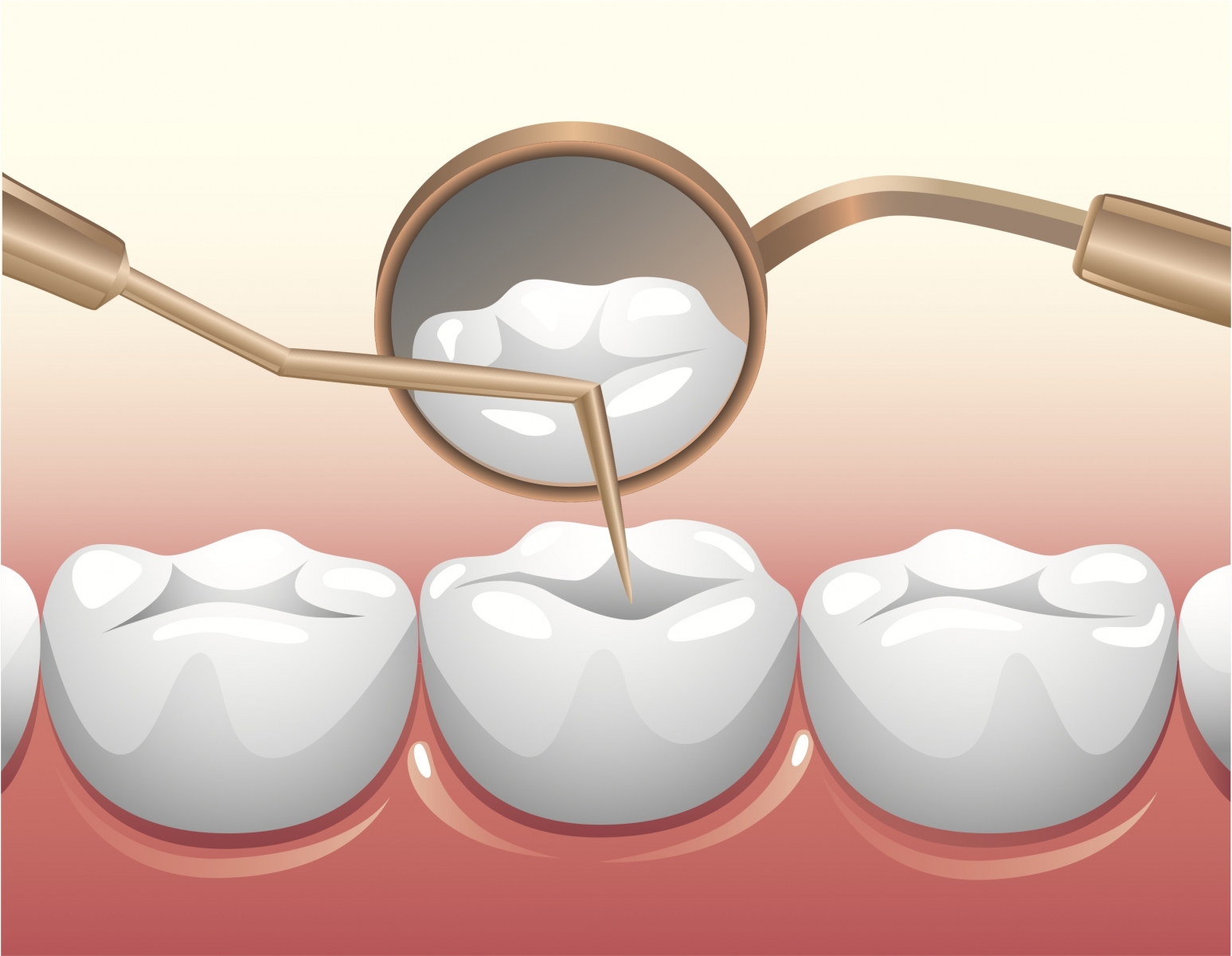 Cách điều trị tủy răng – nội nha