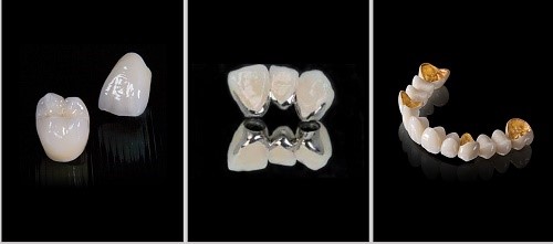 cách giải quyết tình trạng đe nướu do sứ kim loại cách giải quyết tình trạng đe nướu do sứ kim loại