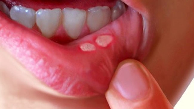 cách phòng ngừa bệnh nhiệt miệng