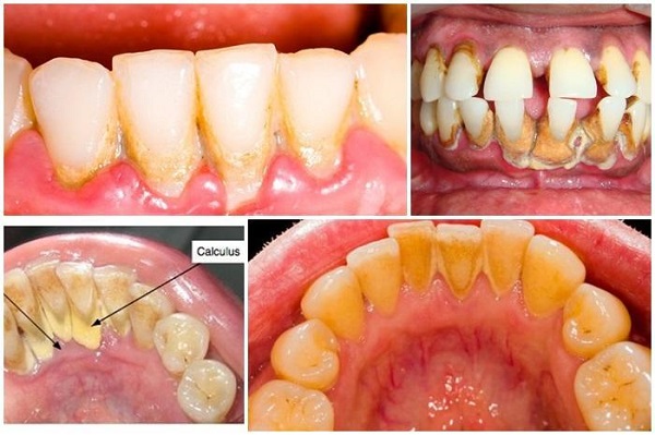 Cạo vôi răng định kỳ bảo vệ sức khỏe răng miệng cho gia đình bạn