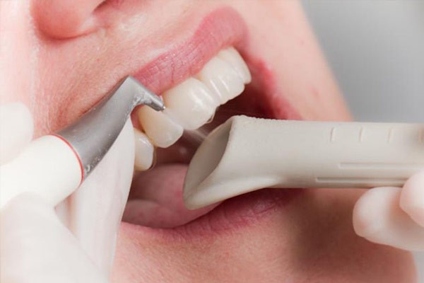 Cạo vôi răng tại tân phú Cạo vôi răng tại tân phú