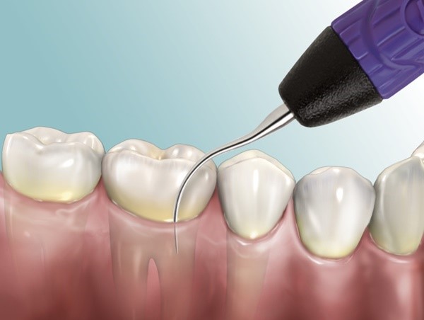 Cạo vôi răng tại tân phú Cạo vôi răng tại tân phú