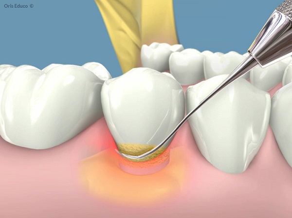 Cạo vôi răng tại quận 10 Cạo vôi răng tại quận 10