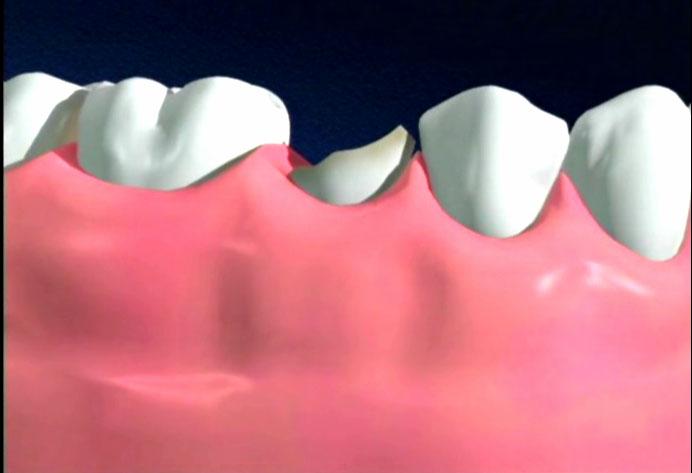 Những kiến thức về bọc răng sứ cần biết Những kiến thức về bọc răng sứ cần biết
