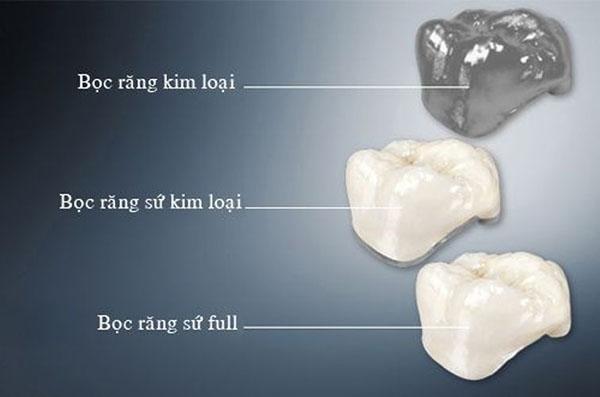 Những kiến thức về bọc răng sứ cần biết