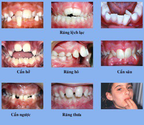 Những kiến thức về bọc răng sứ cần biết Những kiến thức về bọc răng sứ cần biết